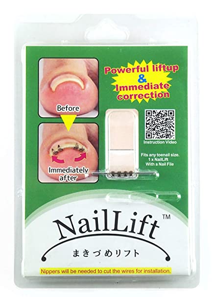 NAILLIFT for ingrown toenail